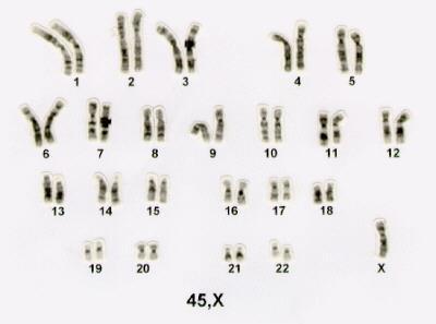 Aberraciones cromosómicas Aneuploidías Gonosómicas Las