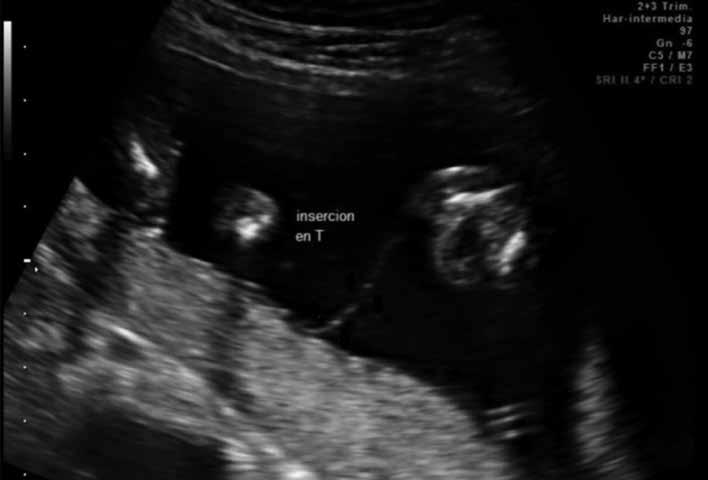 Figura 2. Marcador ecográfico de gestación monocorial en primer trimestre de embarazo: signo T. tico de restricción de crecimiento fetal (12,13).