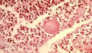 Diagnóstico Histológico Respuesta piogranulomatosa con granulocitos, neutrófilos y eosinófilos, macrófagos, células