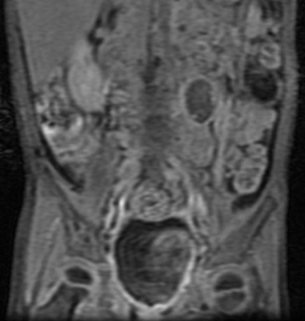 Fig. 8: PacienteA coronal T1