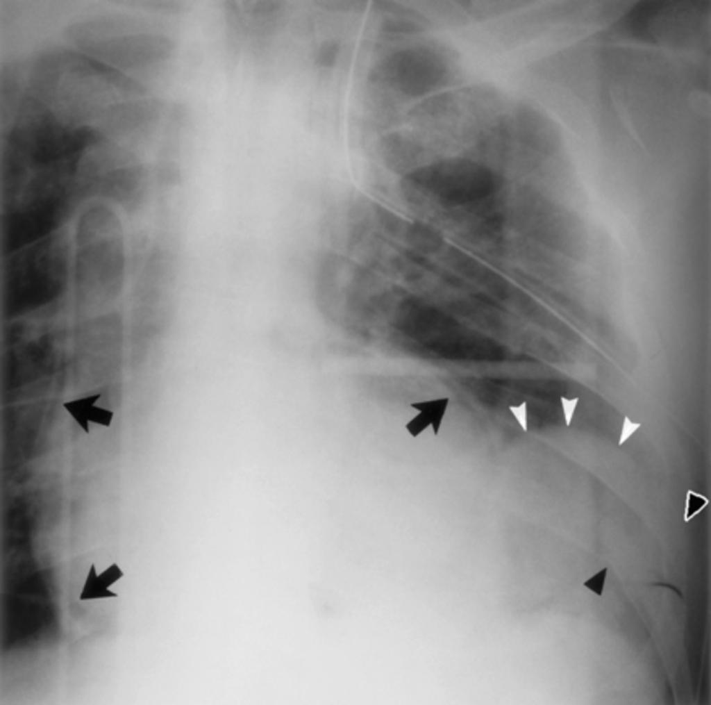 Fig. 3: Neumopericardio (flechas negras).