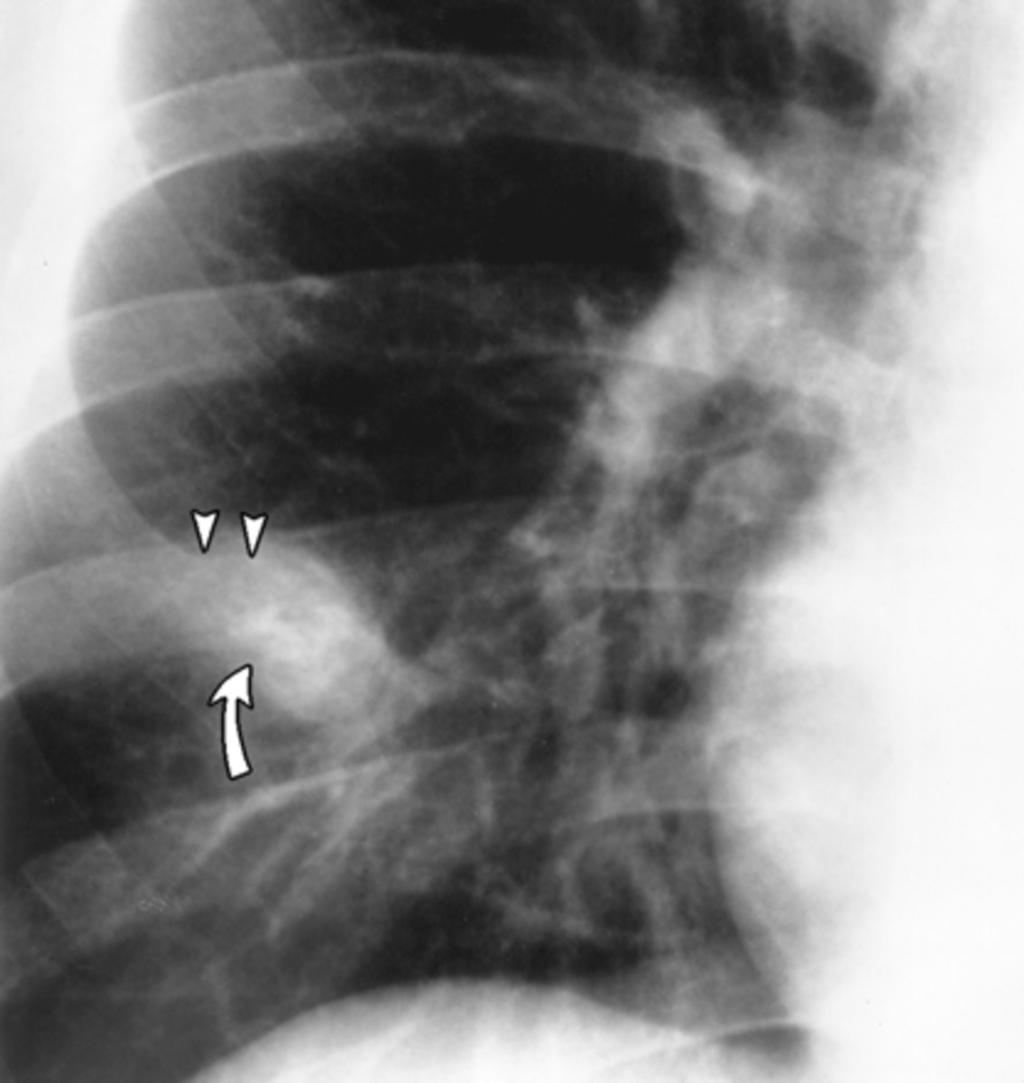 Fig. 4: Osteocondroma(arco anterior