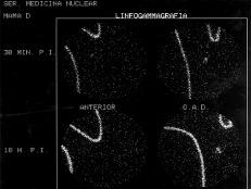 Actualmente, los radiocoloides utilizados en linfogammagrafía son adecuados para la localización y biopsia del Ganglio Centinela (GC), con ayuda o no de la imagen gammagráfica, mediante una sonda