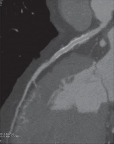 Barragán GO y col. Arteria coronaria izquierda única 217 identificación de calcio y un estudio con contraste en fase arterial para la evaluación de la anatomía coronaria.