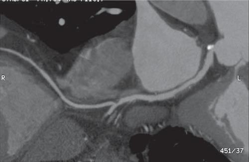 218 Barragán GO y col. Arteria coronaria izquierda única coronarias invasivas.