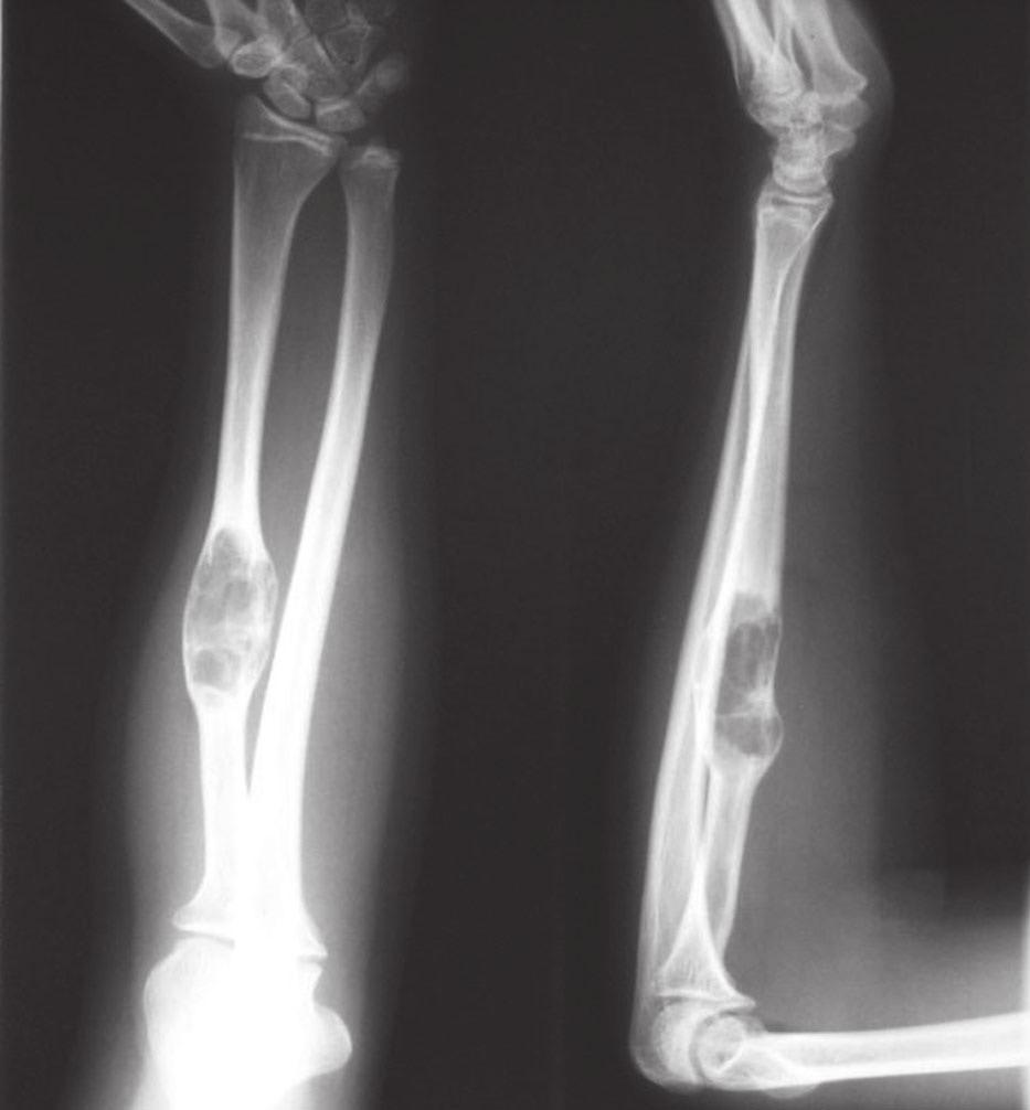Radiografías anteroposterior y lateral del antebrazo, en las que se observa lesión cavitaria, que corresponde a quiste óseo aneurismático en el