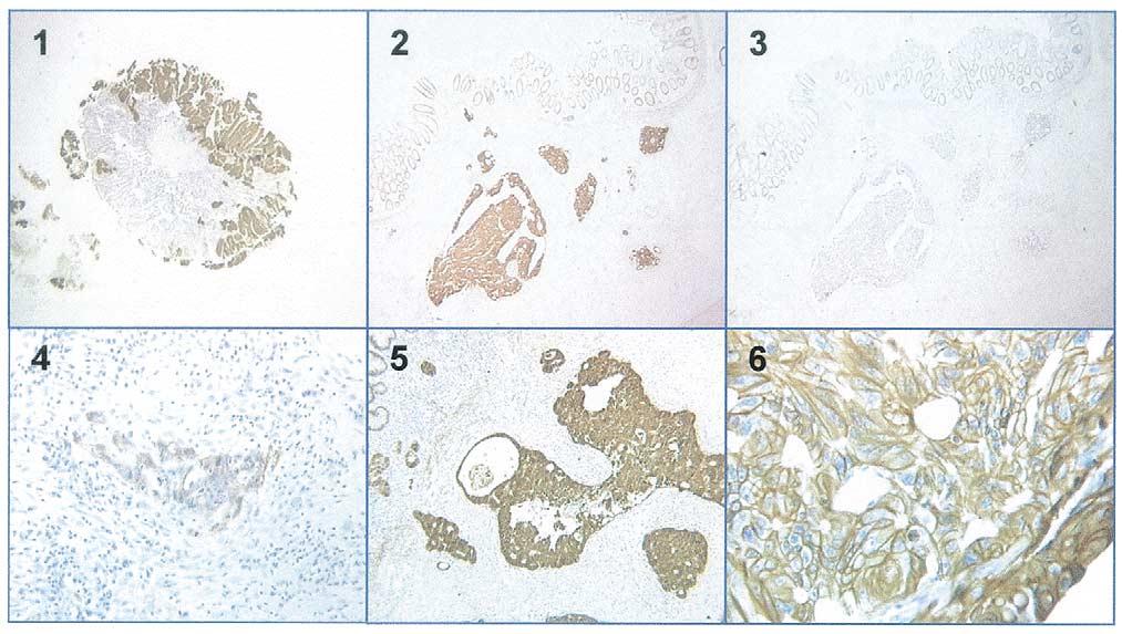 1462 I. J. Radiation Oncology Biology Physics Volume 54, Number 5, 2002 Fig. 1. Immunohistochemistry for EGFR in colorectal cancer: (1) Strong positivity of tumor cells in endoscopic biopsy ( 20).