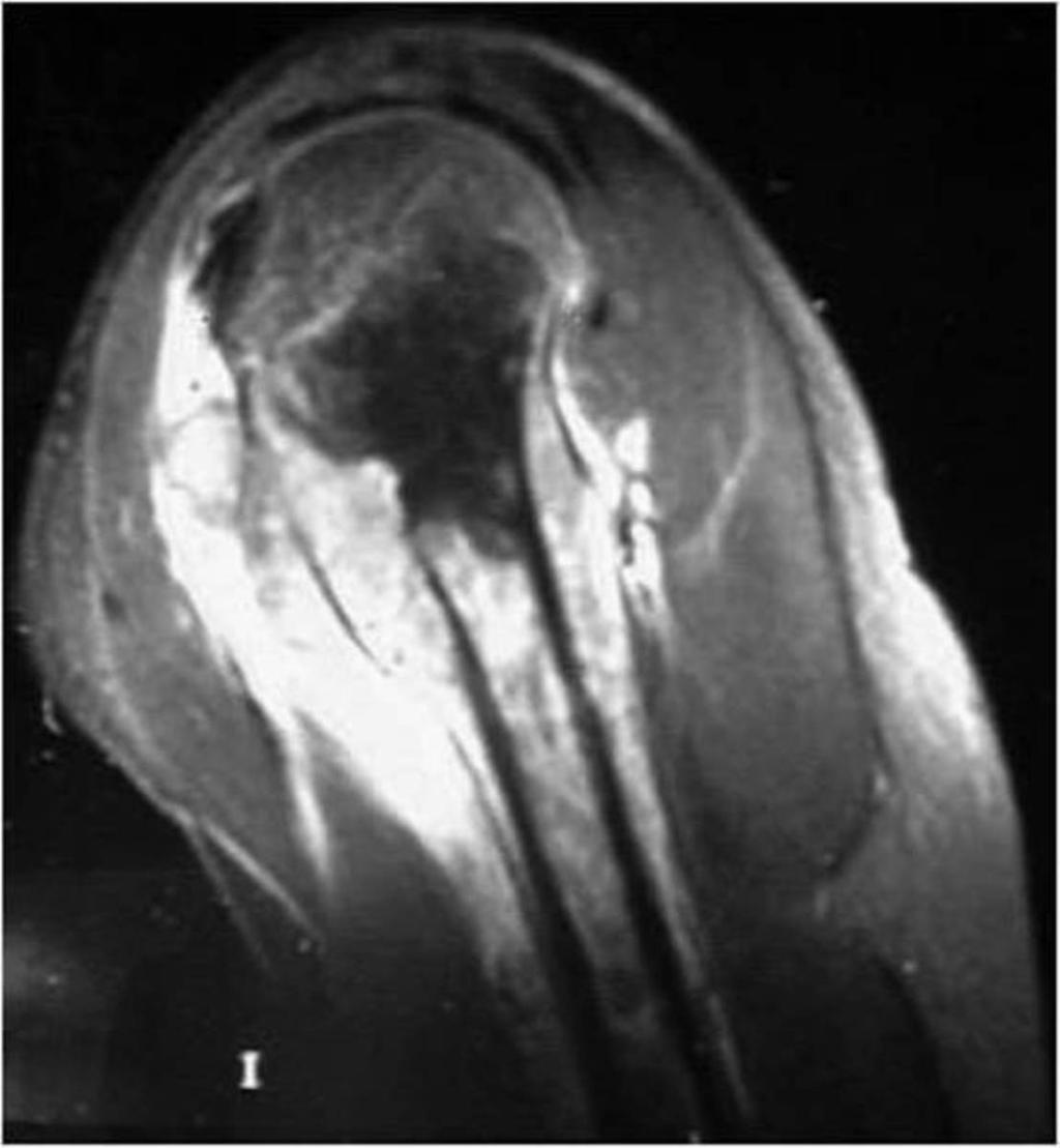 Fig. 21: Osteosarcoma convencional. La flecha azul corresponde a matriz osteoide mineralizada como nubes dentro de la cavidad medular.