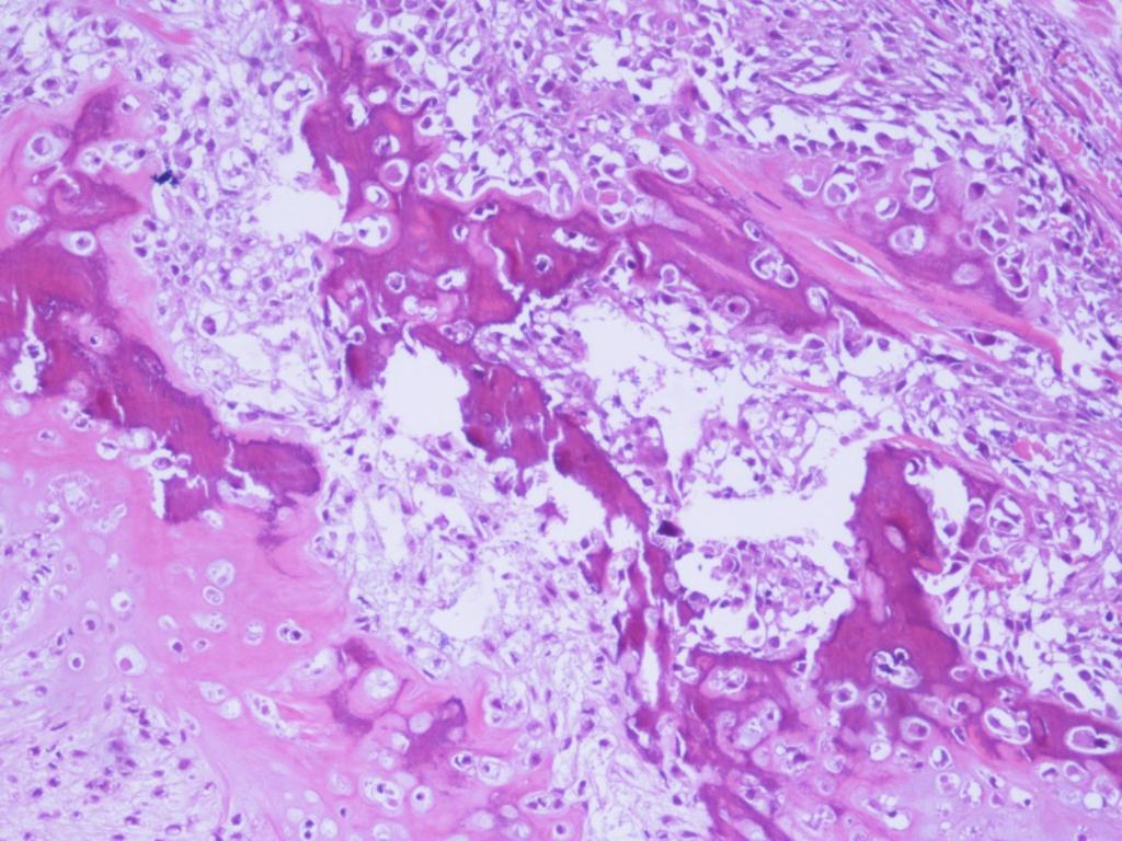 Fig. 23: Osteosarcoma. H&E. 10x. Tumor maligno de celularidad fusiforme de alto grado productora de osteoide.