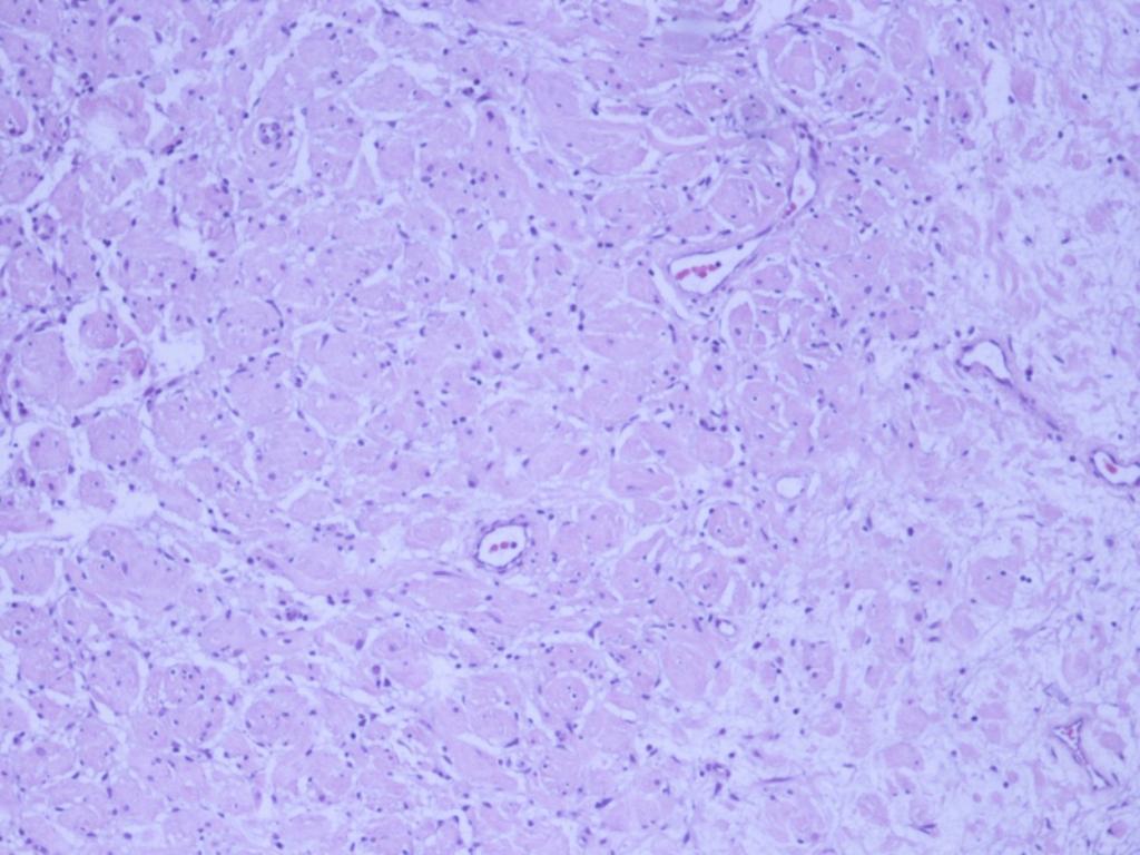 Fig. 34: Neurofibroma. H&E. 10x.