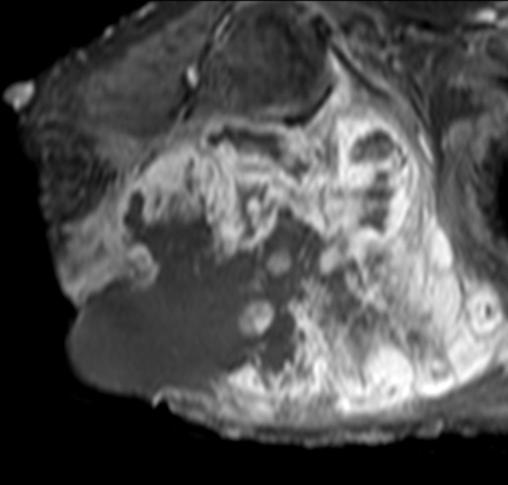 Fig. 36: Neurofibrosarcoma (tumor maligno de la vaina nerviosa).