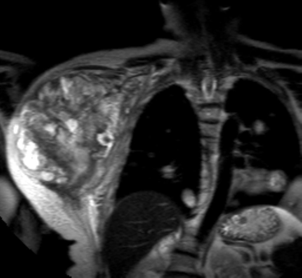Fig. 37: Neurofibrosarcoma (tumor maligno de la vaina