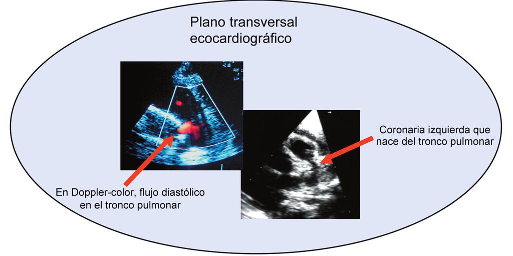 Anomalías coronarias en la edad pediátrica Figura 2. ECG característico en origen anómalo de la coronaria izquierda (ondas Q en DI, avl y precordiales izquierdas). grafía para su diagnóstico exacto.