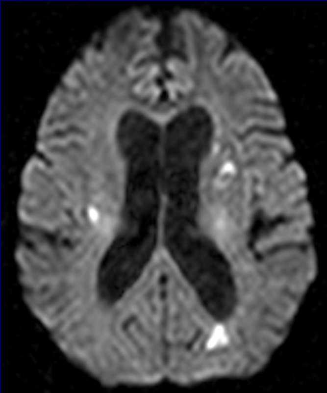 Enfermedad embolica cerebral La embolia en las arterias cerebrales es la causa más frecuente de los CV isquémicos.