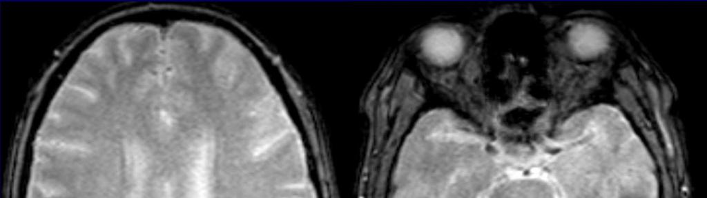 ngiopatía amiloide Se caracteriza por deposito de material amiloide en los vasos de pequeño y mediano
