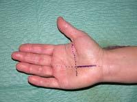 MEDISAN 2013; 17(9):5006 Grupo III: síntomas persistentes de parestesias y dolor, daño neural grave, marcada atrofia tenar y cutánea, así como pérdida sensitiva notable y destreza de la mano.