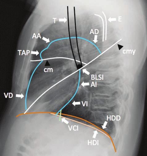 ANATOMÍA BÁSICA EN LA RADIOGRAFÍA DE TÓRAX la radiografía anteroposterior y permite detectar lesiones localizadas en zonas de difícil detección como detrás del corazón, cerca del mediastino o cerca