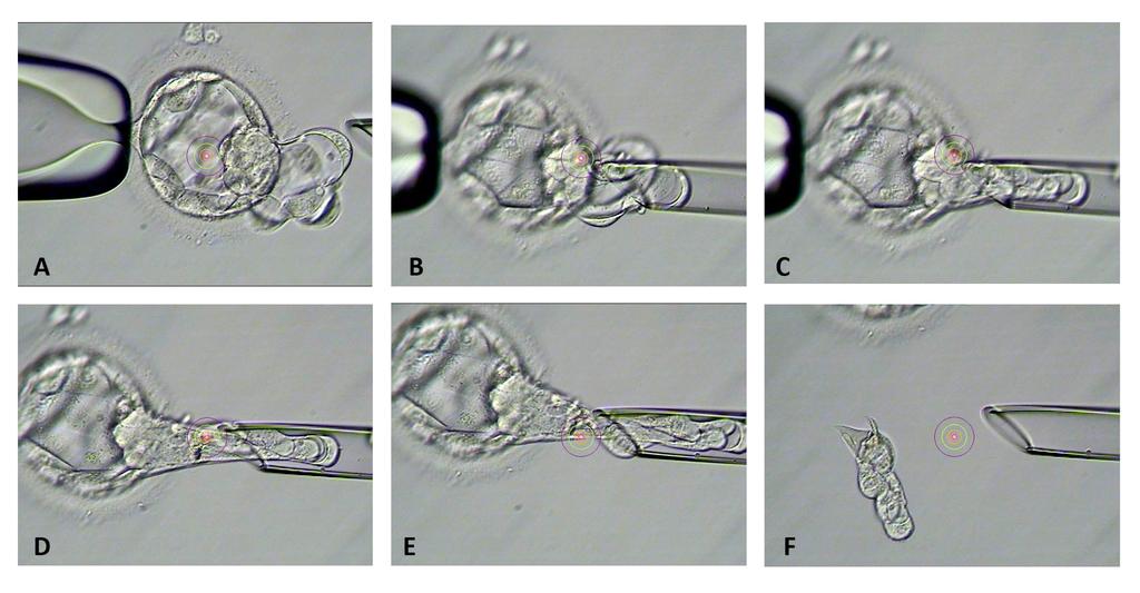 Para separar las células los pulsos de láser pueden ayudar Esta técnica se puede ver facilitada, realizando una incison en la membrana pelucida del embrion en día 4 de evolución, dejar evolucionar a
