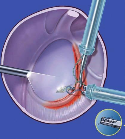 Perforación del complejo capsulolabral con el gancho de sutura, y pasaje del hilo portador mediante