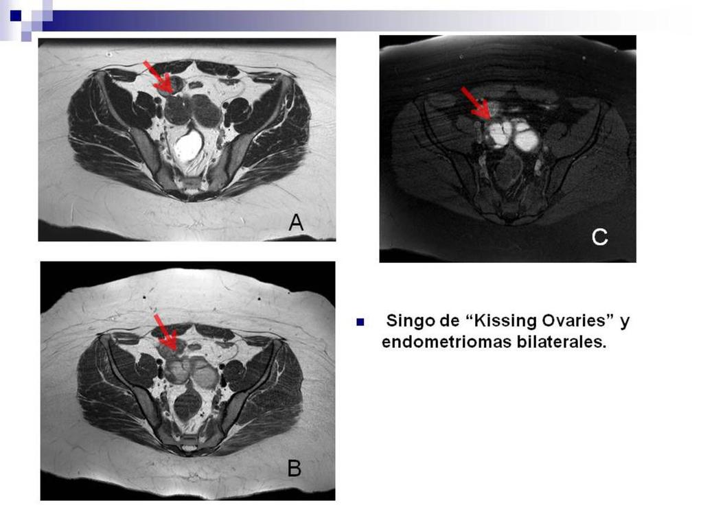 Fig. 5: T2 axial (A), T1 axial (B) y T1 supresión grasa (C)donde vemos ambos ovarios medializados (flechas rojas en A, B y C) con presencia de lesiones hiperintensas en