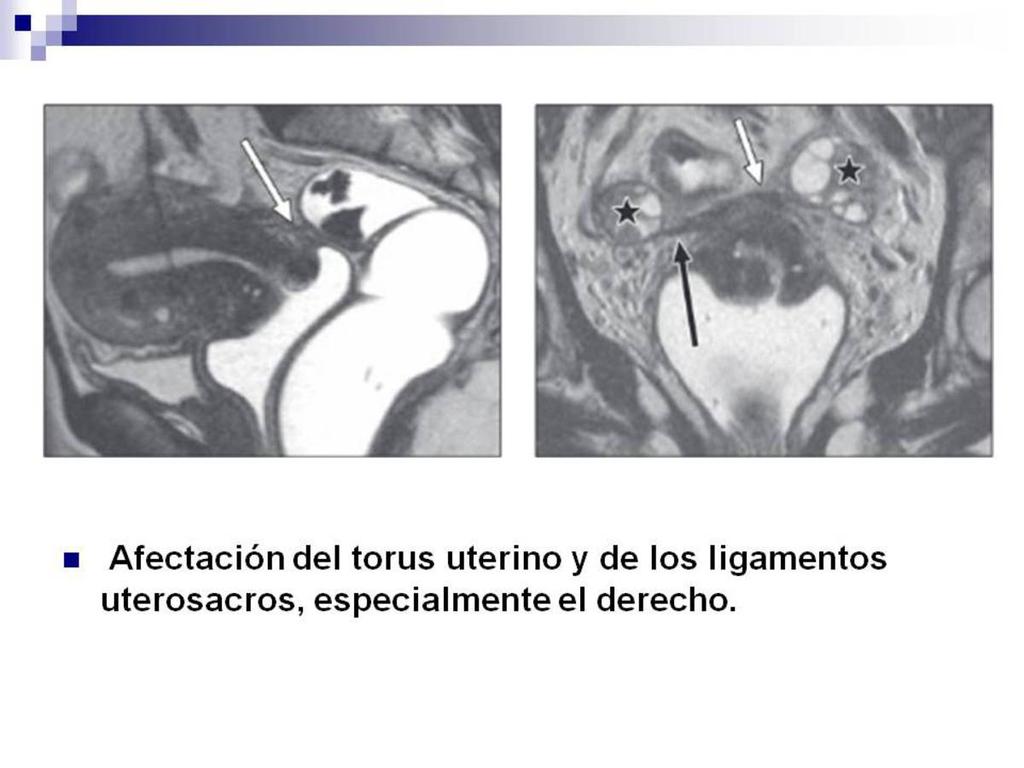 Fig. 15: Secuancia T2 sagital y coronal donde vemos un aspecto nodular del torus uterino (flecha blanca en ambas imagenes) y un