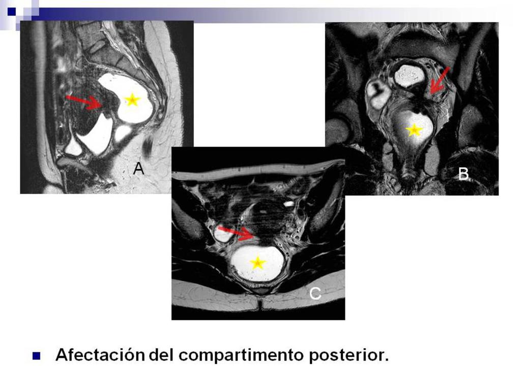 Fig. 16: Secuencias T2 sagital (A), coronal (B) y axial (C) donde vemos una placa hipointensa de endometriosis profunda (flecha roja en A, B y C) afectando el espacio