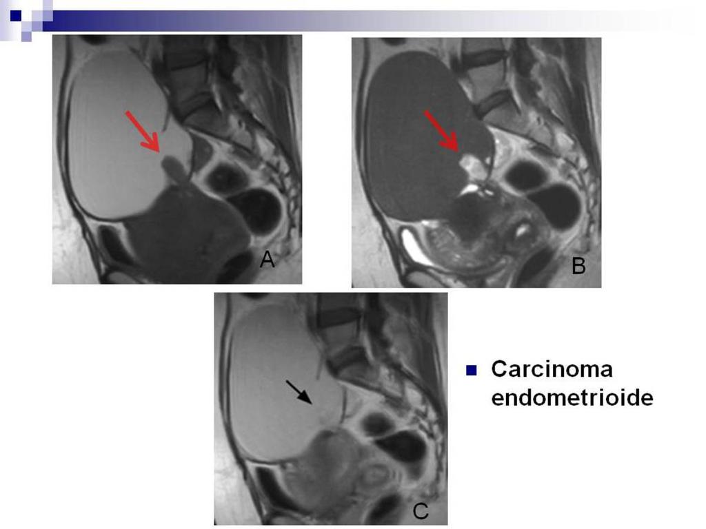 Fig. 21: secuencias sagitales T1(A), T2 (B) y T1 tras Gadolinio (C). Gran endometrioma ovárico con presencia de un pequeño nódulo mural en su vertiente posteroinferior (flechas rojas en A Y B).