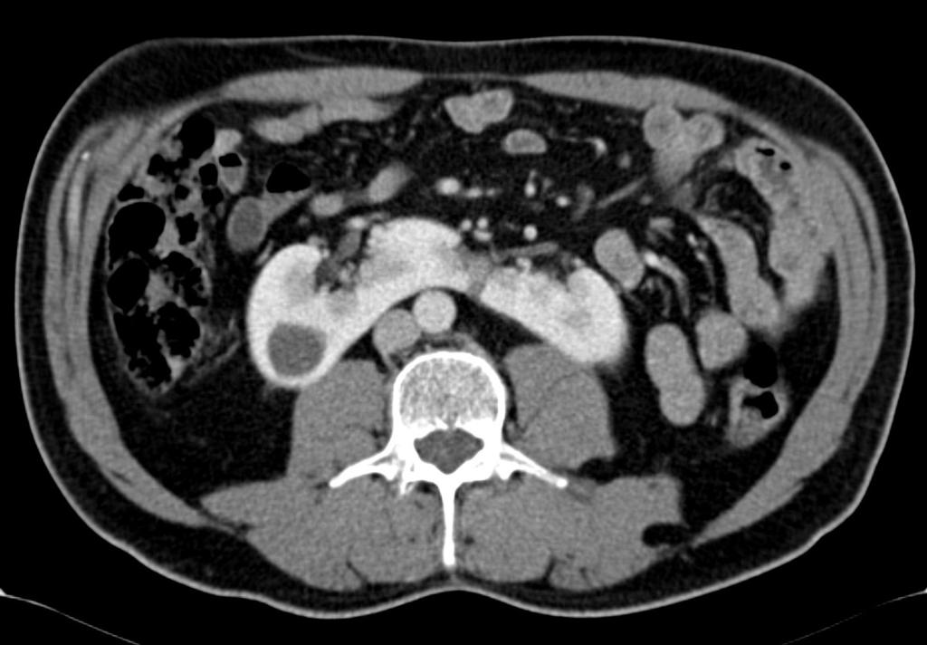 Fig. 3: Corte axial de TC abdominal.