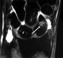 Las fracturas incompletas ESTE o fracturas DOCUMENTO no desalojadas ES ELABORADO del escafoides POR (hasta MEDI- 40% de los casos) suelen no ser GRAPHIC diagnosticadas por estudios de rayos X simples.
