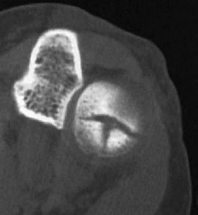 Presentaron en el 4,5% lesiones asociadas (3% con fractura lumbar). Tipo IV (fig. 2D): corresponde a una fractura tipo I, II o III asociada a luxación de codo.