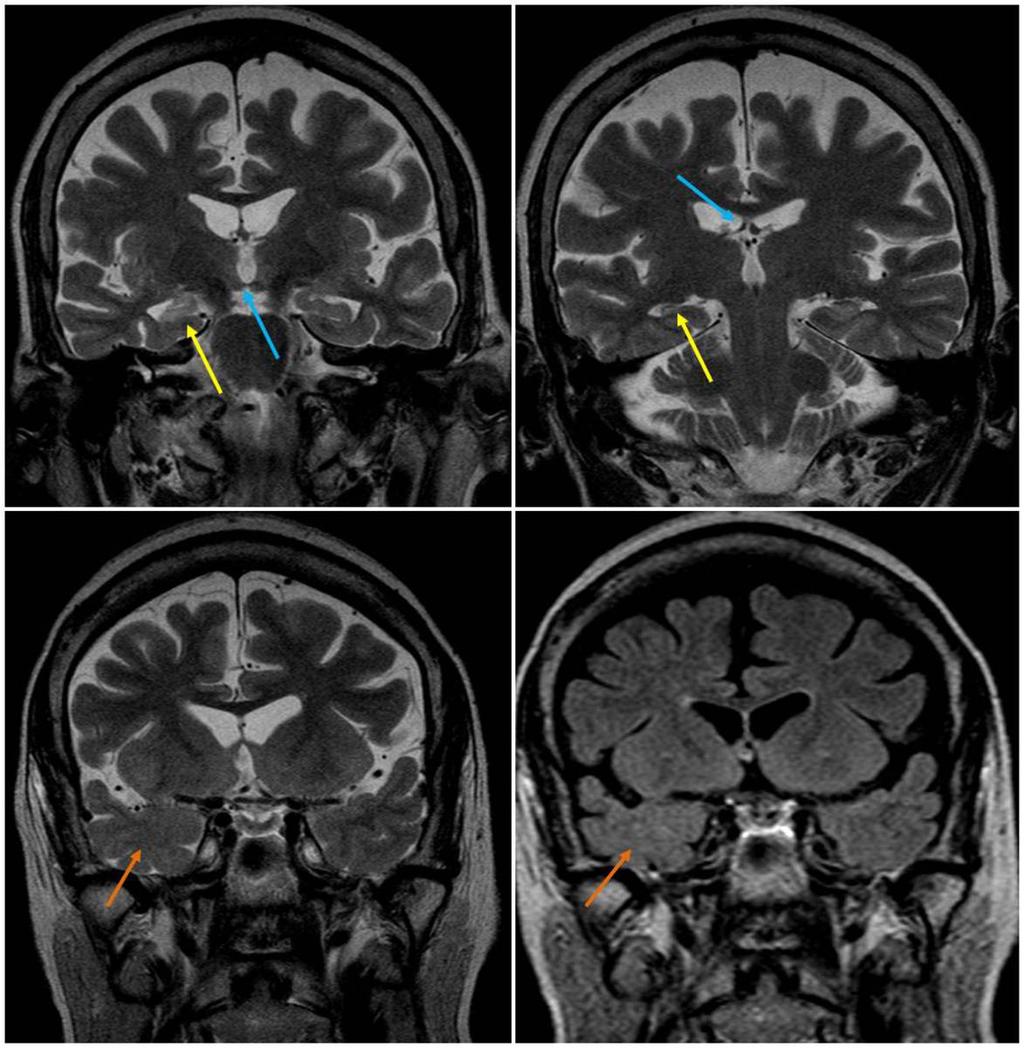 Fig. 2: Esclerosis mesial derecha (flechas amarillas). Existen también signos indirectos como de atrofia del fornix y del cuerpo mamilar ipsilateral (flehcas azules).