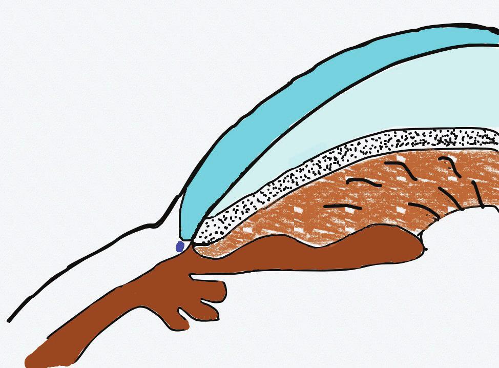 538 Córnea Canal de Schlemm Malla trabecular Esclera Escleral Iris Espolón Figura 1. Esquema del ángulo iridocorneal: corte sagital. terior, que lleva a un abombamiento del iris hacia adelante.