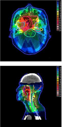 Radioterapia: rayos X o g vs hadrones (p, 12 C) Energía depositada frente a la