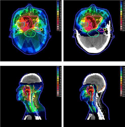 Radioterapia: rayos X o g vs hadrones (p, 12