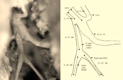 Nervio facial extrapetroso: ramos preparatoídeos / Rodrigo Montes F y col 371 Figura 1. Tronco común para el VPMD y MEH. A izquierda: fotografía del NF en su emergencia por el AEM.