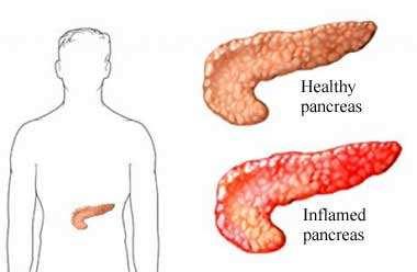 Efectos adversos de Exenatide: Pancreatitis aguda Casos tras la comercialización en sujetos con otros factores de riesgo para pancreatitis. Mecanismo fisiopatólógico no conocido.
