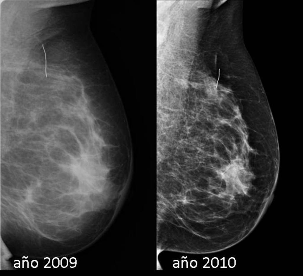 Fig. 14: Antecedentes de CC mama izquierda por CDI grado III con extensa necrosis en el año 2006.