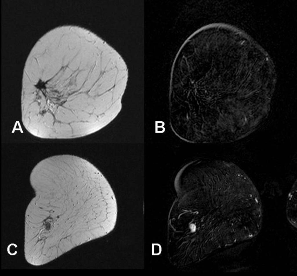 Fig. 17: RM correspondiente al caso Fig 16. A: T2 coronal sin contraste e.v. A nivel de la cicatriz se visualiza lesión hipointensa de contornos espiculados.
