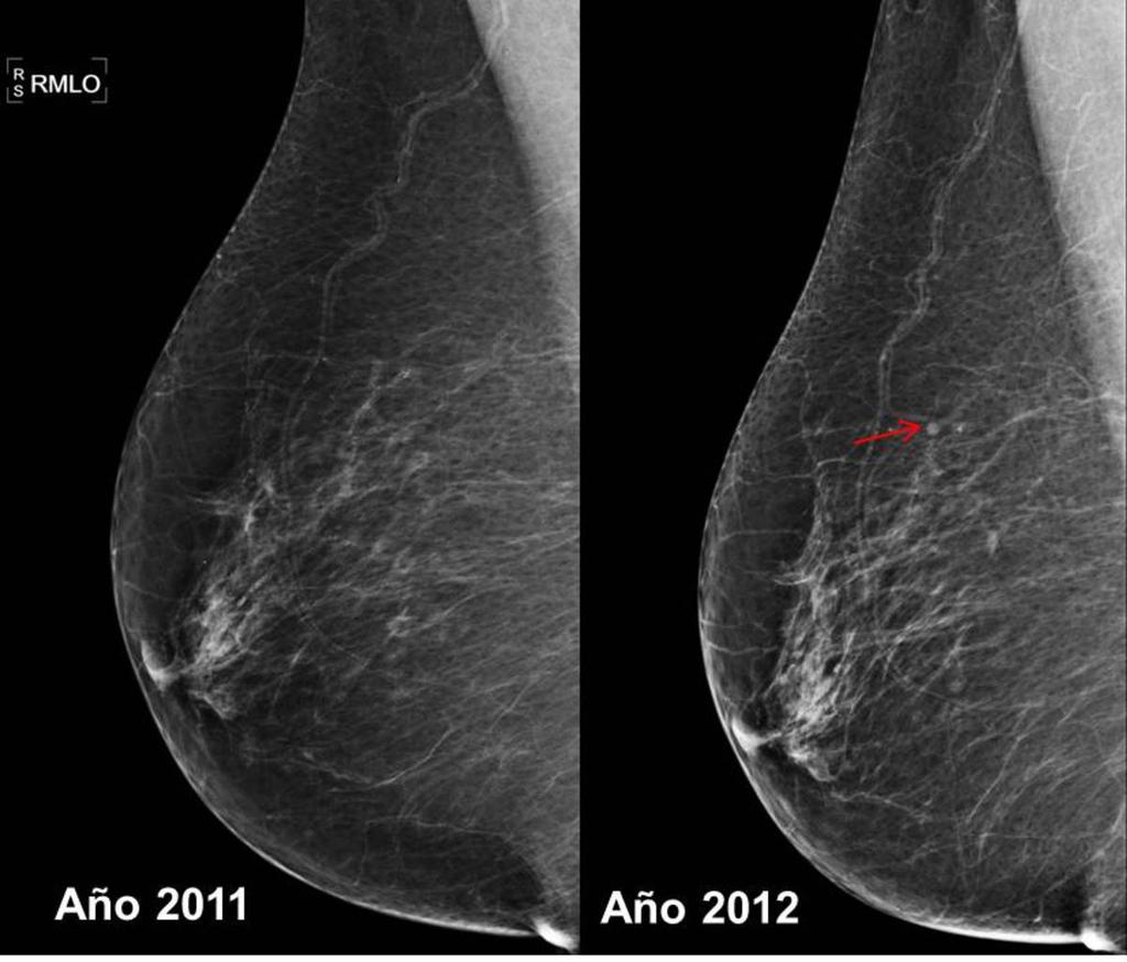 Fig. 2: Antecedentes de cirugía conservadora en la mama izquierda por CDI grado II nueve años antes.
