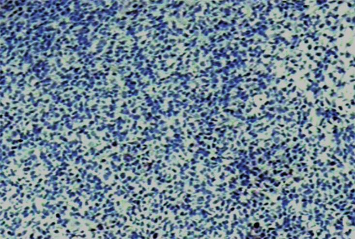 Estos linfomas tienen un componente celular heteromorfo constituído por células de pequeña y mediana talla de tipo monocitoide B, células de tipo centrocito like, y un componente variable de células