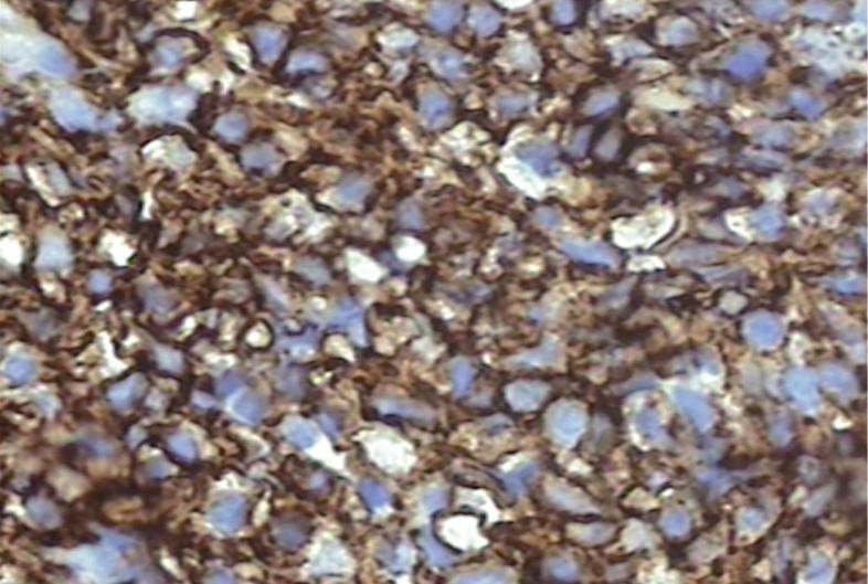 Se observan a menudo PMN de tipo esosinófilo en la superficie del epitelio y la presencia de lesión linfoepitelial, definida por la destrucción de las estructuras glandulares por las células