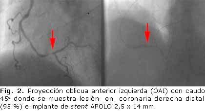 Hemodinámica Se realizó coronariografía y se detectó lesión en segmento distal de arteria coronaria derecha (ACD - 95 %).