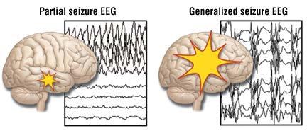 Tipo de Epilepsia En general, se encuentra una mayor tasa de fracaso escolar en epilepsias sintomáticas y criptogénicas con respecto a las epilepsias