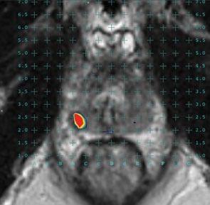 La imagen 3D final puede ser manipulada en la pantalla del ordenador por lo que el urólogo puede ver desde todos los ángulos, además el área