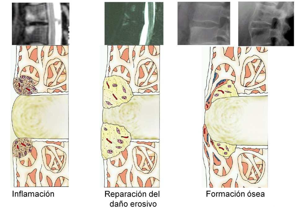 Introducción La EA se caracteriza, además de por la inflamación, por la neoformación de hueso, sobre todo en el esqueleto axial en forma de sindesmofitos.