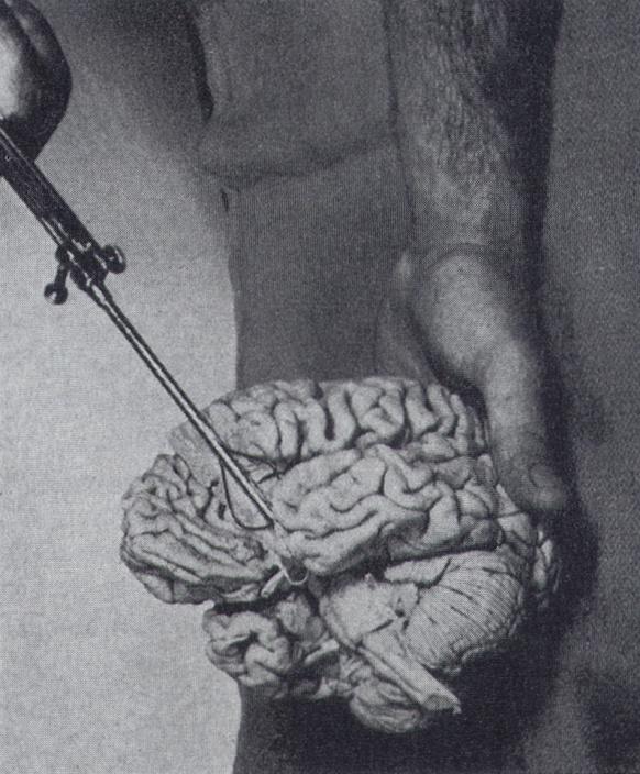 14 Fig.8: Demostración del abordaje realizado por Moniz- Almeida. (Leucotomia Frontal) En 1936, Walter Freeman [Fig.9] estableció contactos con Moniz para aplicar su técnica en Estados Unidos.