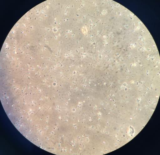 Fig 1. Muestra se semen observada en microscopio óptico en 40x para el conteo de la movilidad espermática. No requiere ninguna tinción. Aglutinación.