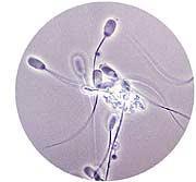 A) B) Procedimiento: Fig 3. A) Aglutinación específica, B) Agregación inespecífica de espermatozoides a otros tipos celulares. Homogenizar la muestra con una pipeta Pasteur.