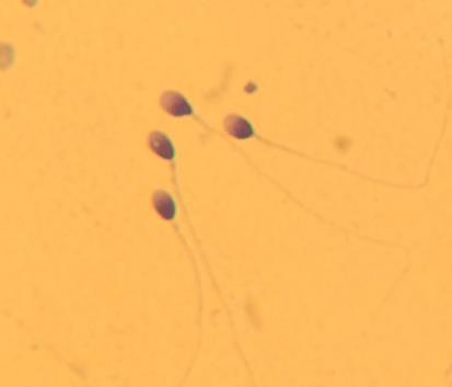 1) 2) Fig 10. 1) Espermatozoides con morfología normal. 2) Espermatozoides con defectos de A) Cabeza, B) Pieza media, C) Cola. Algunos presentan más de un defecto.