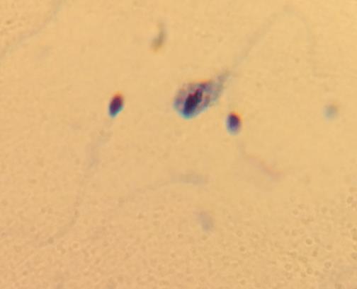 en el conteo. Fig 11. Muestra de semen con presencia de A) Espermátides, B) Leucocitos.